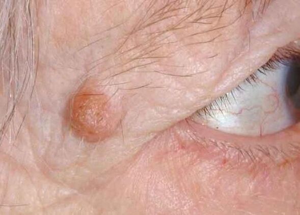 eyelid papilloma