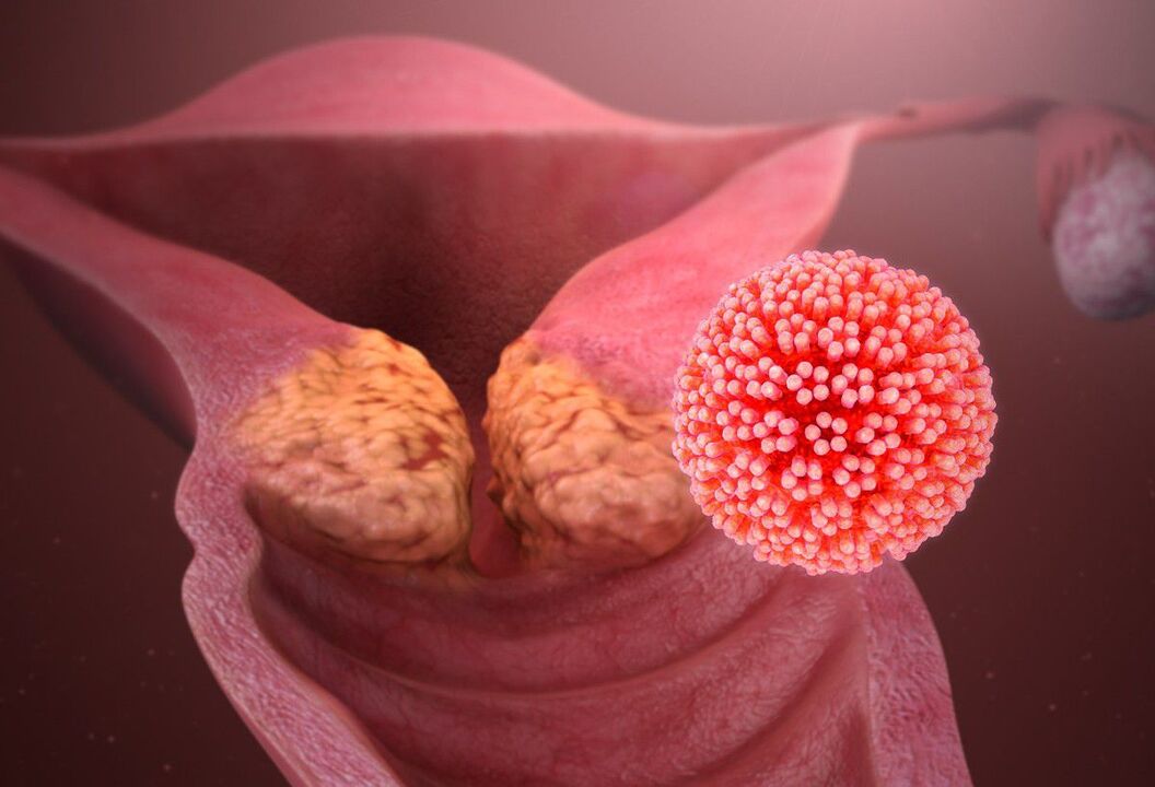 HPV cervical lesion