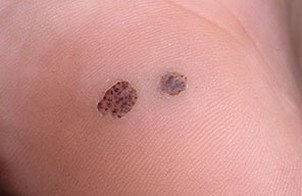 a wart on the palm of your hand