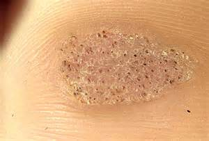 a wart on the skin