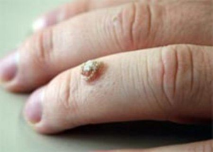 warts on your finger