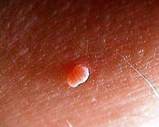 Papilloma on the body