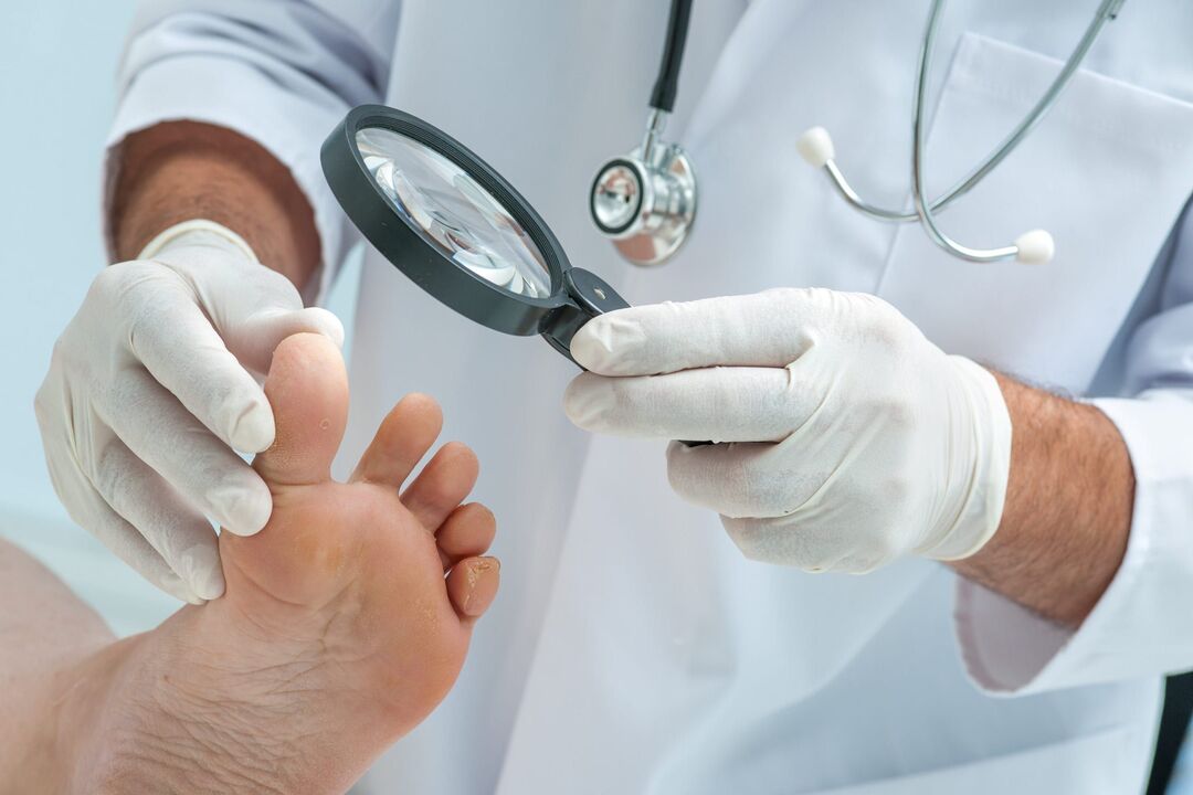 treatment of warts by a doctor
